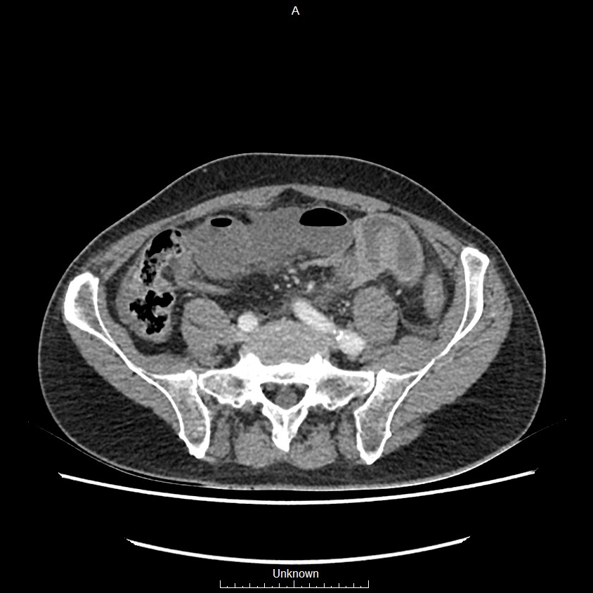 Closed loop bowel obstruction and ischemia (Radiopaedia 86959-103180 A 60).jpg