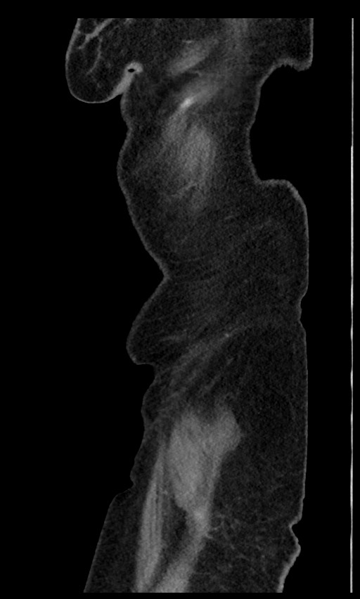 Closed loop small bowel obstruction - adhesions (Radiopaedia 59269-66611 C 6).jpg