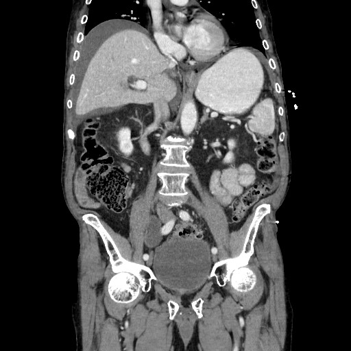 File:Closed loop small bowel obstruction - adhesive disease and hemorrhagic ischemia (Radiopaedia 86831-102990 B 67).jpg