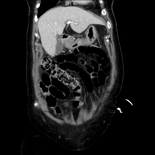 Closed loop small bowel obstruction due to adhesive bands - early and late images (Radiopaedia 83830-99014 B 37).jpg