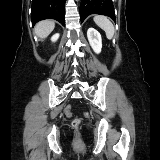 Closed loop small bowel obstruction due to adhesive bands - early and late images (Radiopaedia 83830-99014 B 94).jpg