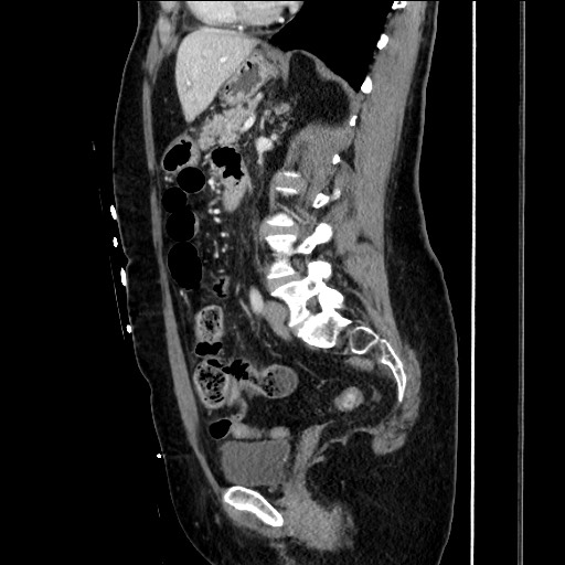 Closed loop small bowel obstruction due to adhesive bands - early and late images (Radiopaedia 83830-99014 C 106).jpg