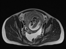 Closed loop small bowel obstruction in pregnancy (MRI) (Radiopaedia 87637-104031 D 28).jpg