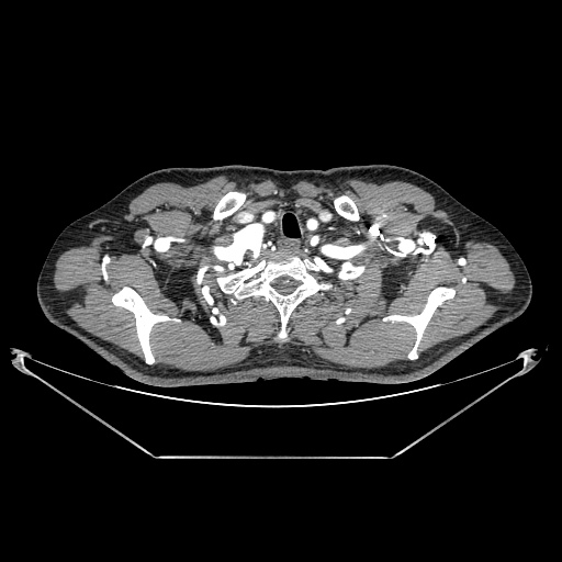 Coarctation of aorta (Radiopaedia 25384-25630 A 2).jpg