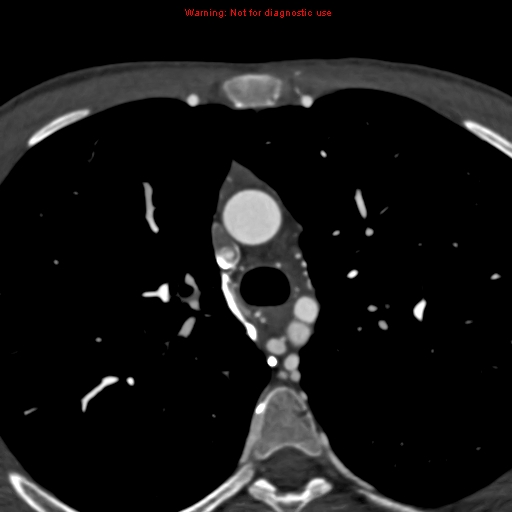 File:Coarctation of the aorta (Radiopaedia 12461-12697 A 113).jpg