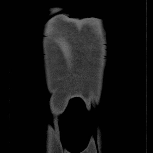 File:Coarctation of the aorta (Radiopaedia 17427-17116 A 3).jpg