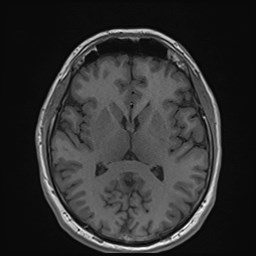 File:Cochlear incomplete partition type III associated with hypothalamic hamartoma (Radiopaedia 88756-105498 Axial T1 108).jpg