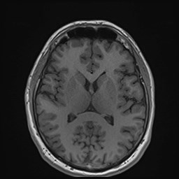 Cochlear incomplete partition type III associated with hypothalamic hamartoma (Radiopaedia 88756-105498 Axial T1 110).jpg