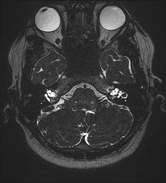 Cochlear incomplete partition type III associated with hypothalamic hamartoma (Radiopaedia 88756-105498 Axial T2 66).jpg