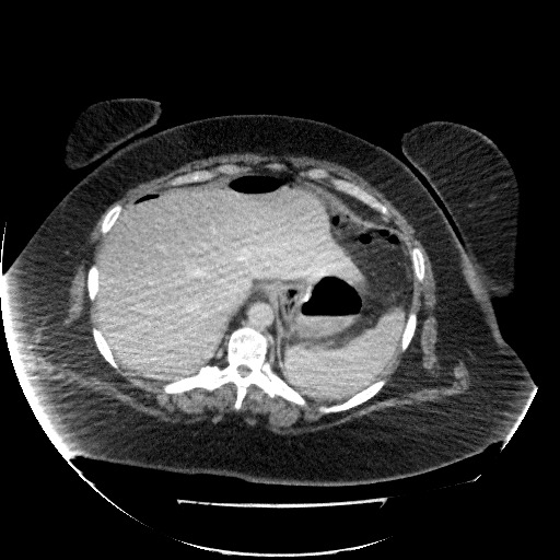 File:Collection due to leak after sleeve gastrectomy (Radiopaedia 55504-61972 A 18).jpg