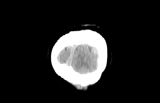 Colloid cyst (Radiopaedia 88663-105373 Coronal non-contrast 68).jpg