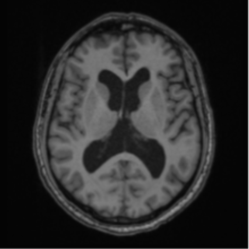 File:Colloid cyst of the third ventricle (Radiopaedia 86571-102662 Axial T1 42).png