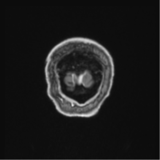 Colloid cyst of the third ventricle (Radiopaedia 86571-102662 Coronal T1 C+ 5).png