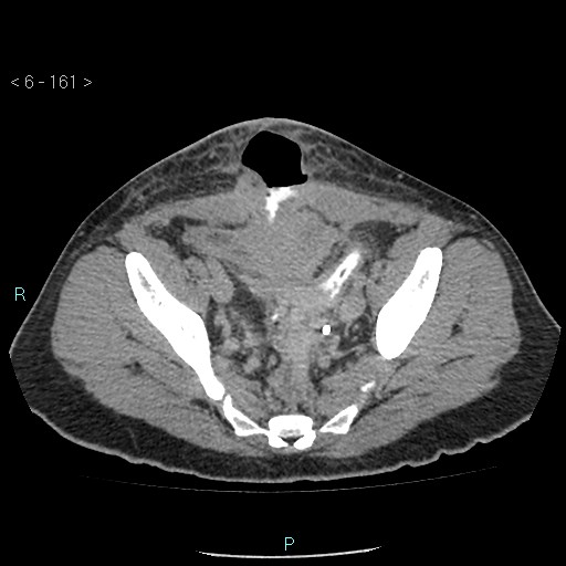 File:Colo-cutaneous fistula (Radiopaedia 40531-43129 A 67).jpg