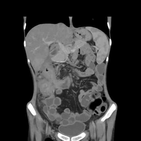 File:Colocolic fistula - Crohn disease (Radiopaedia 57063-63955 B 16).jpg