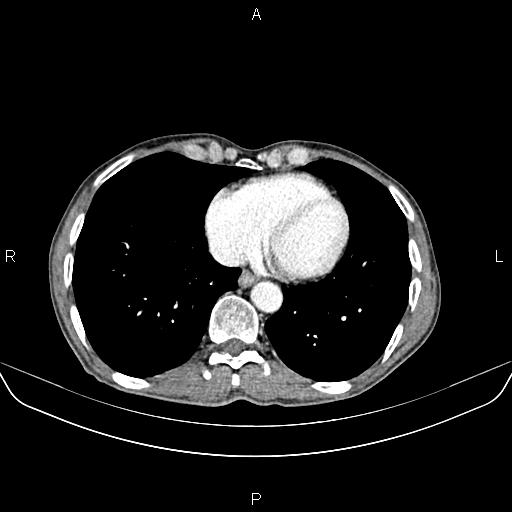 Colon adenocarcinoma - hepatic flexure (Radiopaedia 85635-101395 A 3).jpg