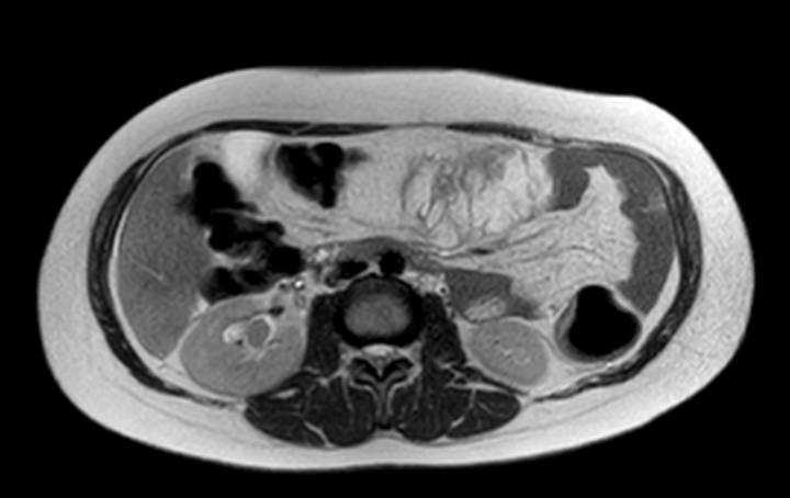 Colon adenocarcinoma with Krukenberg tumors, advanced pregnancy (Radiopaedia 67279-76645 Axial T2 48).jpg