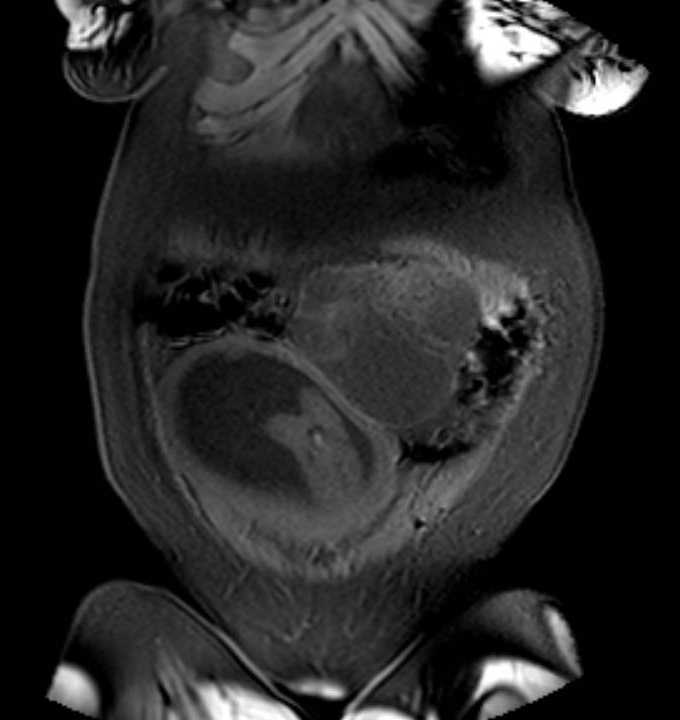 Colon adenocarcinoma with Krukenberg tumors, advanced pregnancy (Radiopaedia 67279-76645 E 12).jpg