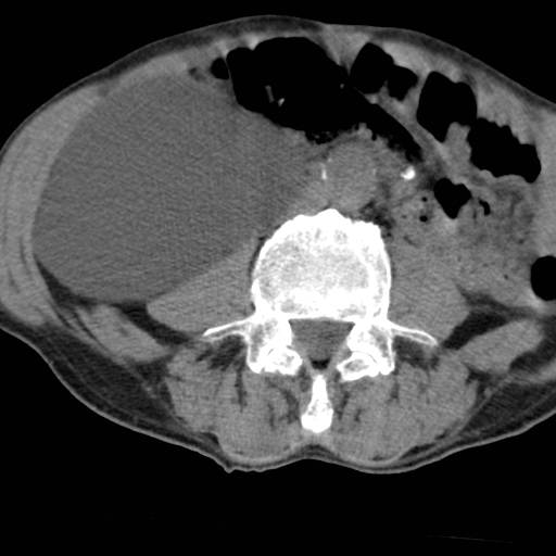 File:Colon cancer with calcified liver metastasis (Radiopaedia 74423-85309 Axial non-contrast 59).jpg