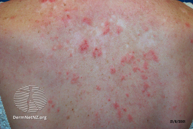 Cutaneous lupus erythematosus (DermNet NZ immune-lupus-erythematosus-2530).jpg