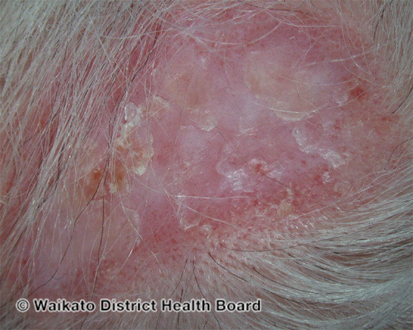 File:Discoid lupus erythematosus (DermNet NZ immune-w-discoid-lupus-03).jpg