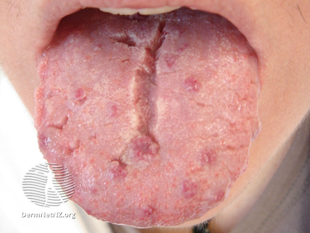 File:Fissured tongue (DermNet NZ site-age-specific-fissured-tongue).jpg