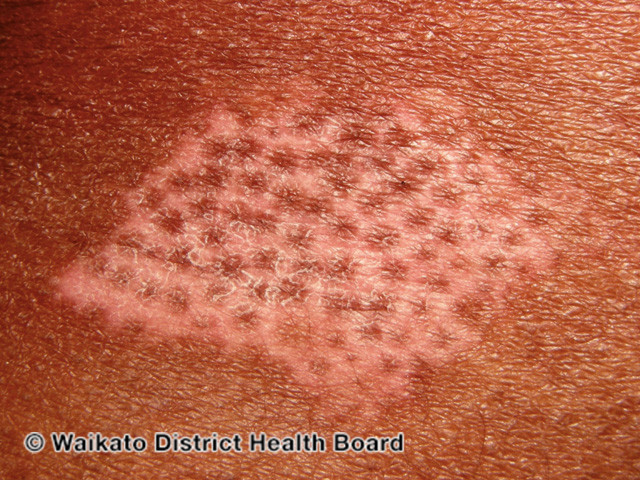 File:Follicular repigmentation (DermNet NZ colour-w-vitiligo-39).jpg