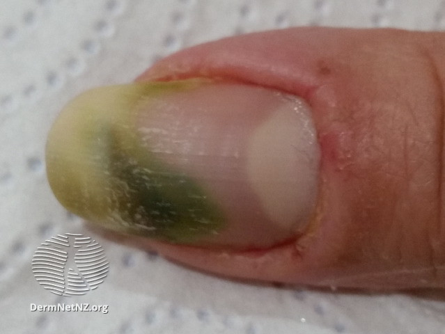 File:Green nail due to pseudomonas infection with paronychia (DermNet NZ green-nail).jpg