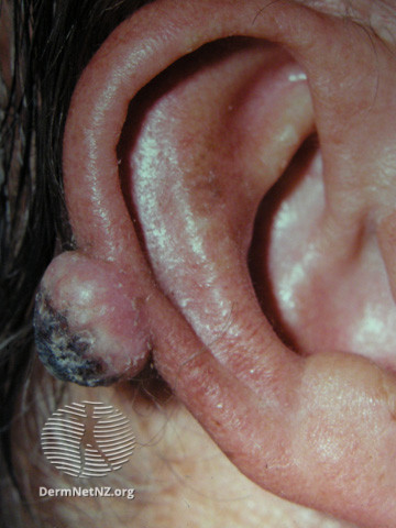 File:Keratoacanthoma (DermNet NZ lesions-ka1).jpg