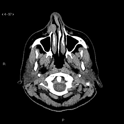 Nasolabial cyst (Radiopaedia 75125-86194 Axial non-contrast 59).jpg