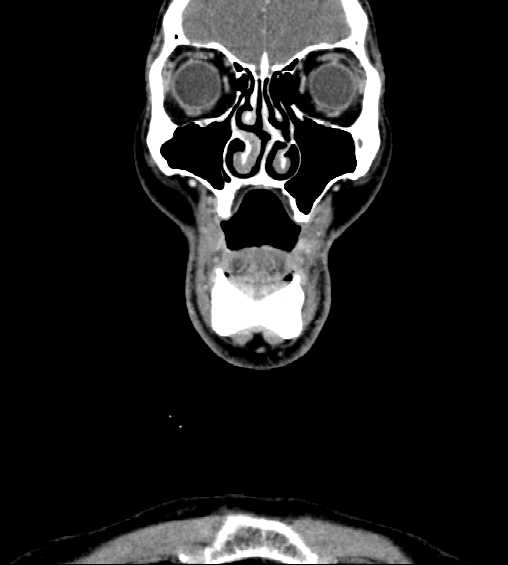 File:Nasopharyngeal carcinoma - infiltrating the clivus (Radiopaedia 62583-70875 D 4).jpg