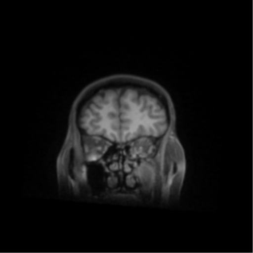 File:Nasopharyngeal carcinoma with cerebral abscess (Radiopaedia 43018-46274 Coronal T1 fat sat 13).png