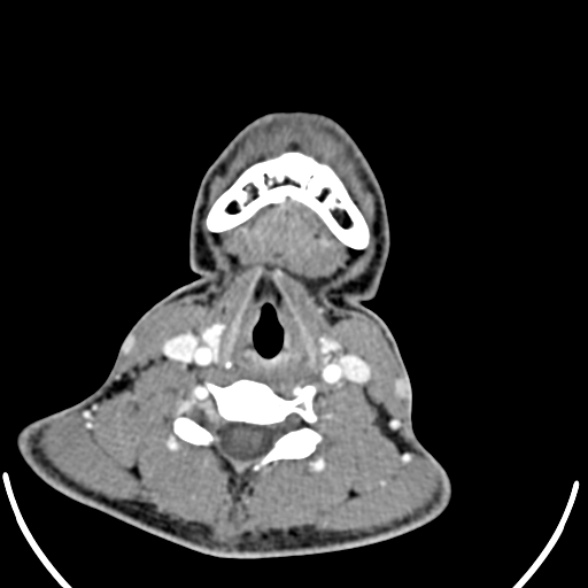 File:Nasopharyngeal carcinoma with skull base invasion (Radiopaedia 53415-59705 A 148).jpg
