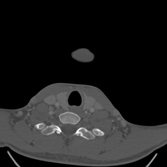 Nasopharyngeal carcinoma with skull base invasion (Radiopaedia 53415-59705 Axial bone window 172).jpg