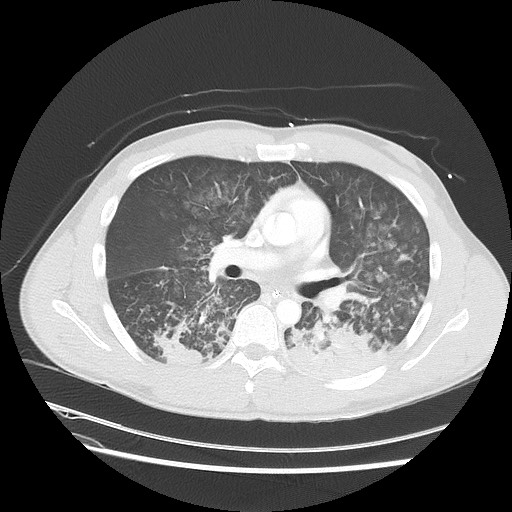 Near-drowning pulmonary edema (Radiopaedia 59457-66814 Axial lung window 28).jpg