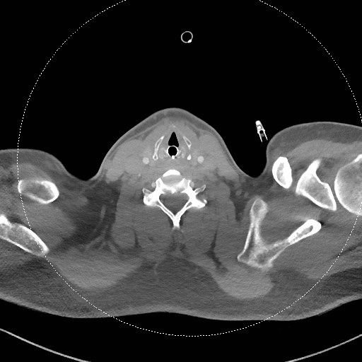 Neck CT angiogram (intraosseous vascular access) (Radiopaedia 55481-61945 B 149).jpg