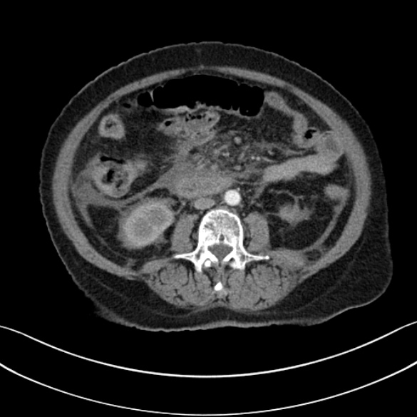 File:Necrotizing emphysematous pancreatitis (Radiopaedia 25727-25893 A 77).jpg