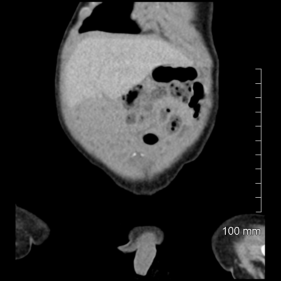 File:Neonatal neuroblastoma (Radiopaedia 56651-63438 Coronal non-contrast 10).jpg