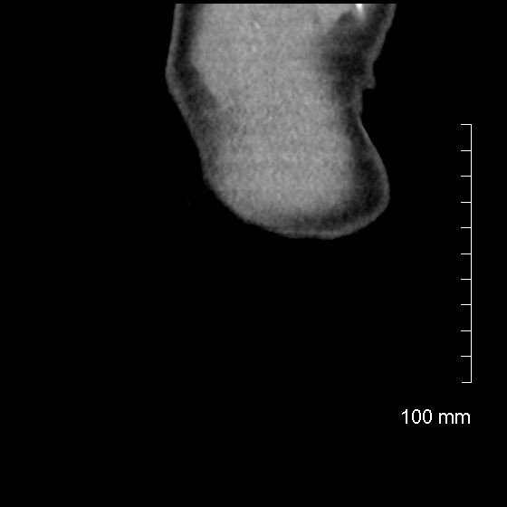 File:Neonatal neuroblastoma (Radiopaedia 56651-63438 Coronal non-contrast 48).jpg