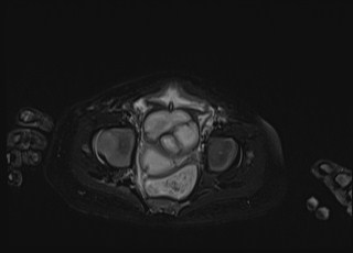 Neonatal prostatic utricle abscess - cyst (Radiopaedia 69511-79394 Axial T2 fat sat 18).jpg