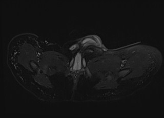 Neonatal prostatic utricle abscess - cyst (Radiopaedia 69511-79394 Axial T2 fat sat 3).jpg