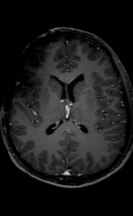 Neuro-Behçet disease (Radiopaedia 90112-107294 Axial T1 C+ 117).jpg