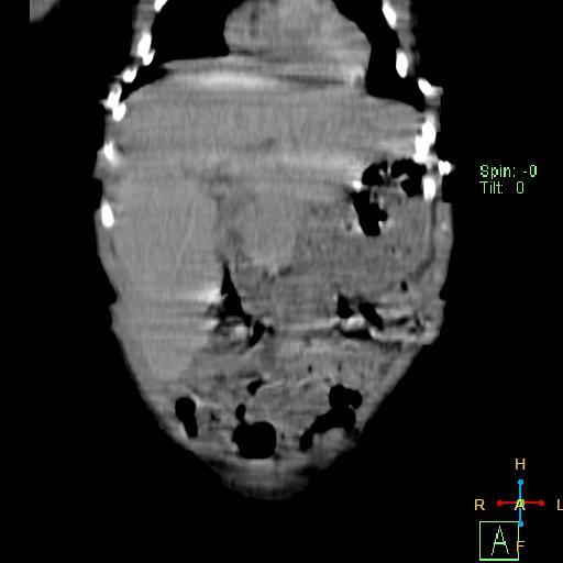 File:Neuroblastoma (Radiopaedia 24751-25016 B 6).jpg