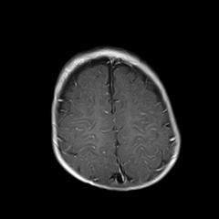 File:Neurofibromatosis type 1 (Radiopaedia 30089-30671 Axial T1 C+ 19).jpg