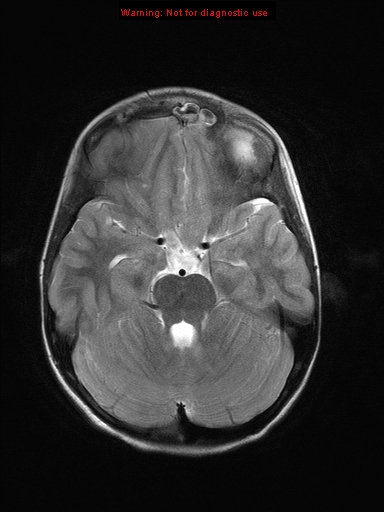 File:Neurofibromatosis type 1 with optic nerve glioma (Radiopaedia 16288-15965 Axial T2 17).jpg