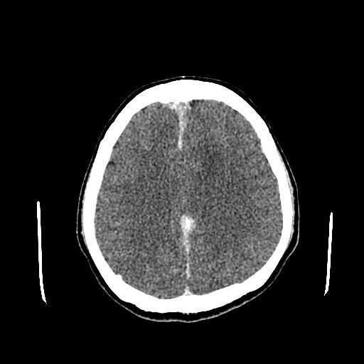 File:Neurofibromatosis type 2 (Radiopaedia 25389-25637 Axial C+ 66).jpg