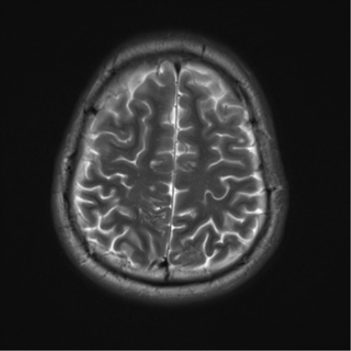 File:Neurofibromatosis type 2 (Radiopaedia 44936-48838 Axial T2 19).png