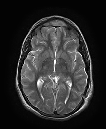 File:Neurofibromatosis type 2 (Radiopaedia 66211-75401 Axial T2 16).jpg