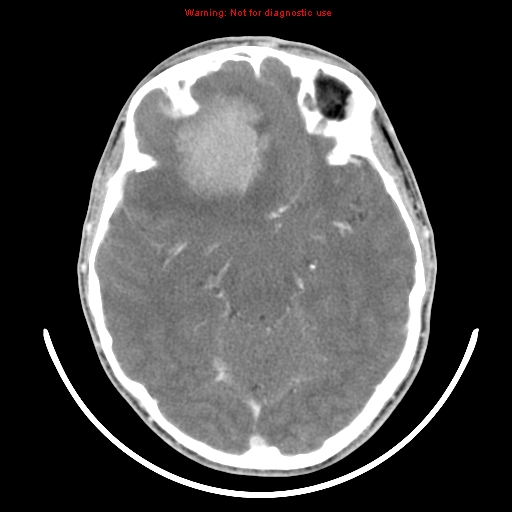 File:Neurofibromatosis type 2 (Radiopaedia 8953-9732 C 14).jpg