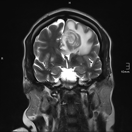 File:Neurotoxoplasmosis - concentric target sign (Radiopaedia 70644-80784 Coronal T2 26).jpg